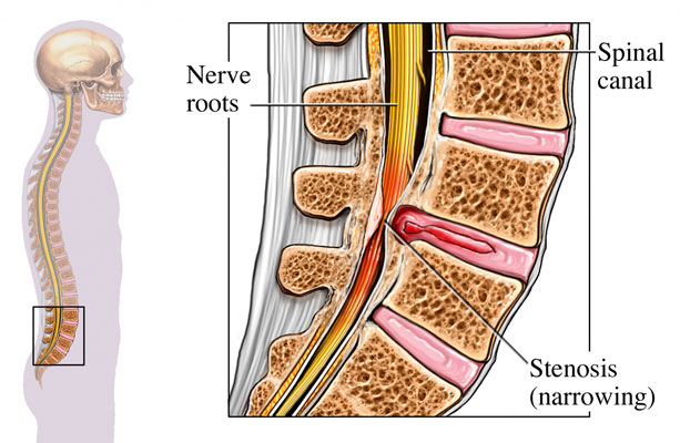 https://www.authchiropractic.com/files/files/uploads/2015/12/Spinal-Stenosis.jpg
